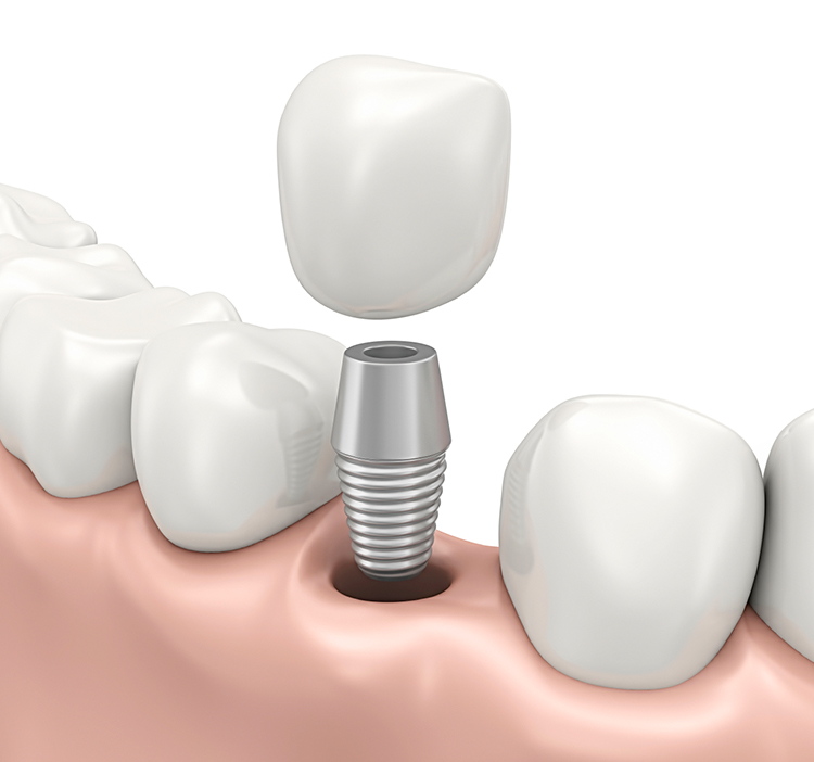 Nashville Dental Implants