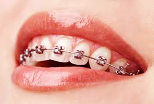 Nashville Orthodontics Braces